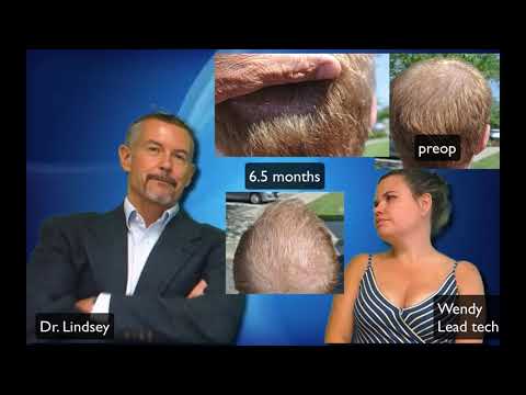 Transgender patient 6.5 months after frontal hair restoration by Dr. Lindsey | McLean | Washington thumbnail