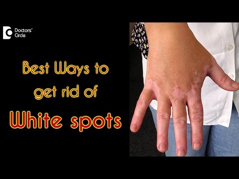 How to treat white spots on the skin? - Dr. Rasya Dixit