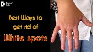 How to treat white spots on the skin? - Dr. Rasya Dixit