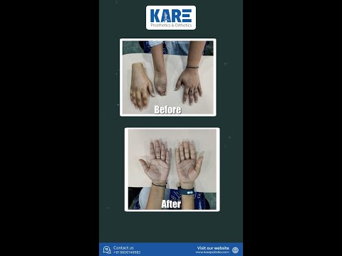 Nylon silicone foot prosthesis