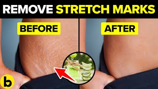 13 Easy Remedies To Get Rid Of Your Stretch Marks
