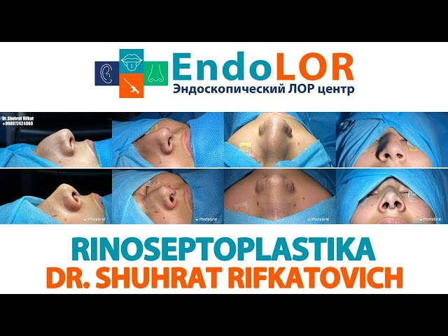 Риносептопластика хирургия в Ташкенте