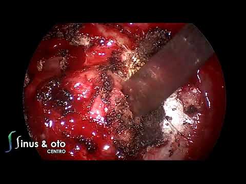 Papillomatosis surgery