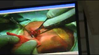 ENT - Dr.Nesem Tala't - Throat - oesophagus - Part 2