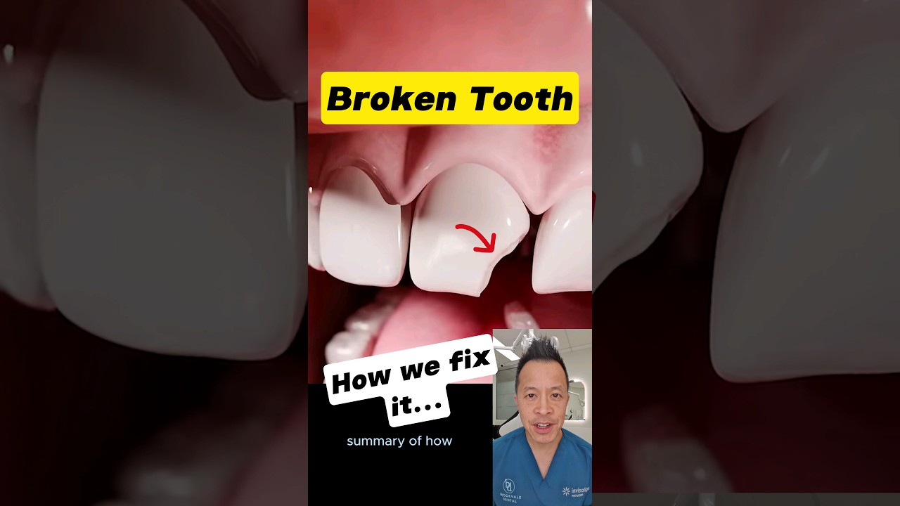 Broken Front Tooth? Here’s How Dentists Restore Your Smile! #dentallan #dentist #shorts