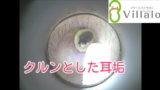 耳掃除動画vol.72「クルンとした耳垢」