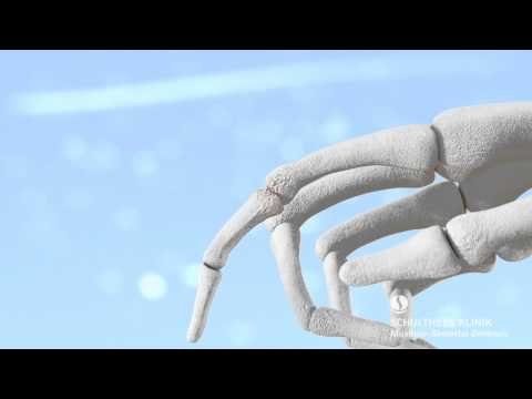 Was ein Knirschen in den Gelenken Behandlung eines Tumors in den Beingelenken