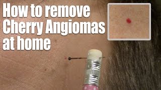 How to remove Red Skin Dots at home Quick & Easy Cherry Angioma treatment