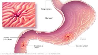 I Almost Died from a Stomach Ulcer (GRAPHIC)