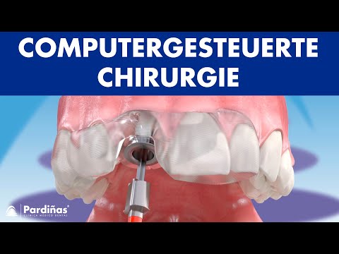 Computergesteuerte Chirurgie zum Zahnimplantaten ©