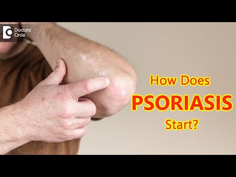 How does psoriasis start? Main Causes & Symptoms - Dr. Chaithanya K S  | Doctors' Circle