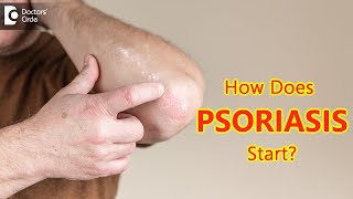 How does psoriasis start? Main Causes & Symptoms - Dr. Chaithanya K S  | Doctors