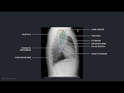 How to Recognize Key Anatomy on Chest Radiographs