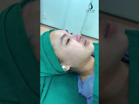 HOÀN THÀNH CA NÂNG MŨI CẤU TRÚC SỤN SURGIFORM - VTM LATIN