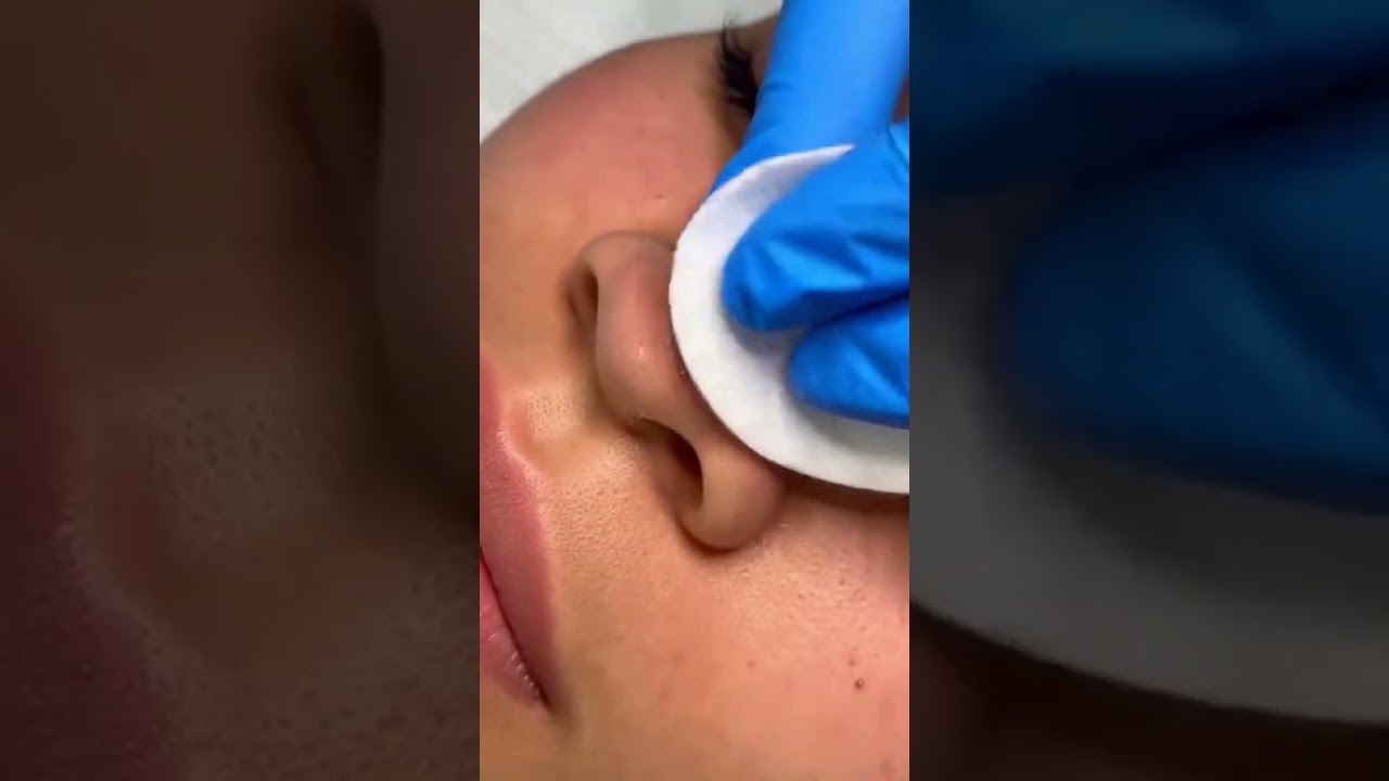 #PimplePixy #AcneClean #SatisfyingExtraction #PimplePopping #skincareasmr