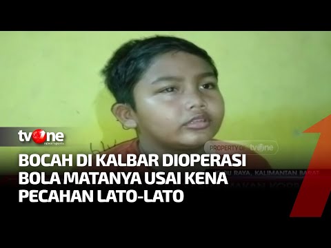 Lato-Lato Memakan Korban, Anak di Kalbar Alami Luka di Mata | Kabar Siang tvOne