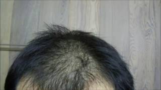 Apple Poly Procyanidin Treatment For Hair Loss - June 2017