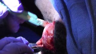 preview picture of video 'Surgery and removal of fatty tumor in Africa'