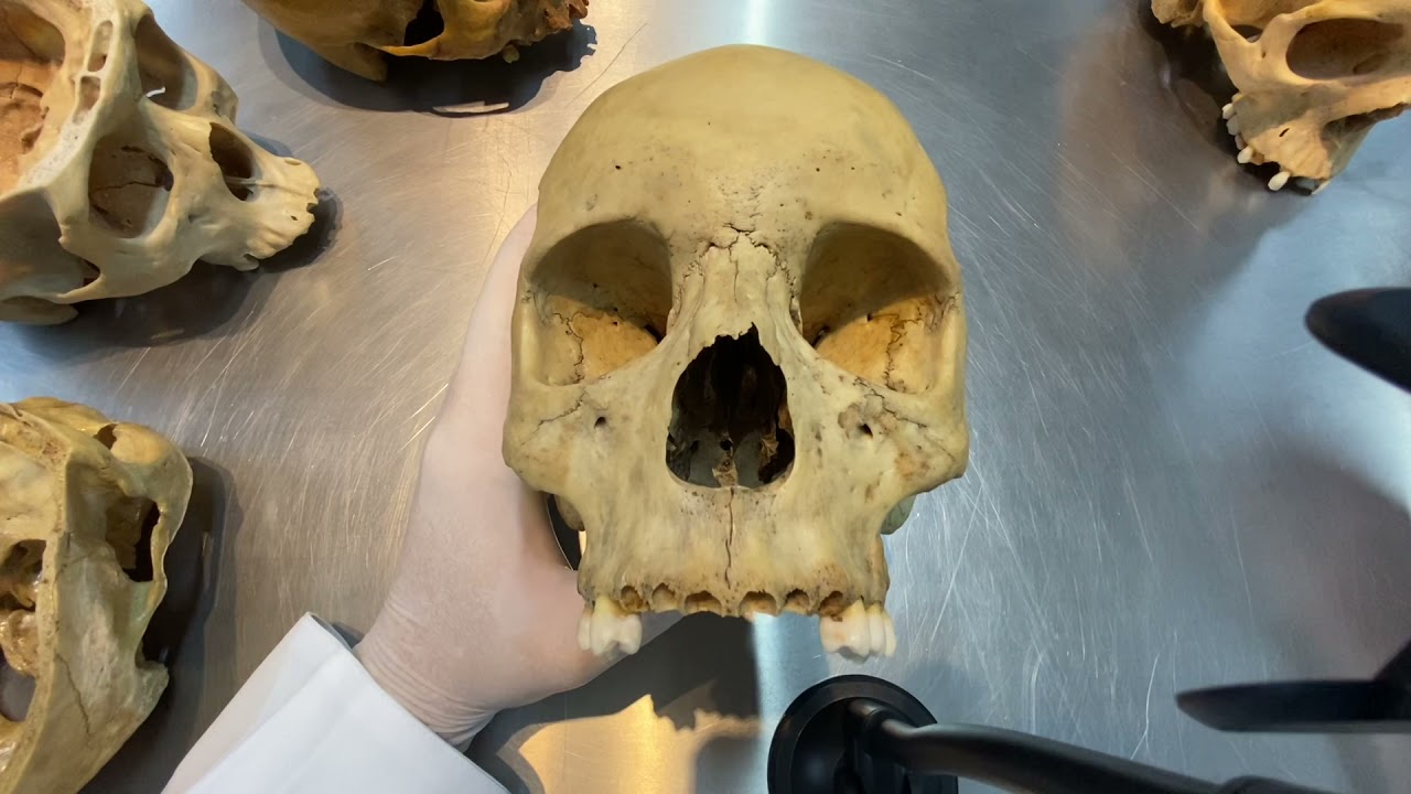 Ossos do Crânio - Neurocrânio e Viscerocrânio