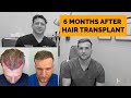 While a hair transplant can drastically change one's appearance for the better, if done correctly...