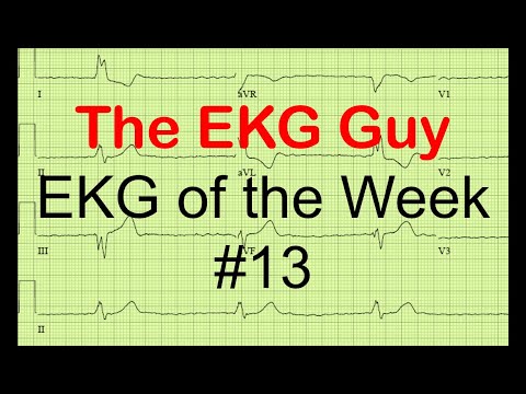 EKG/ECG of the Week #13 | The EKG Guy - www.ekg.md