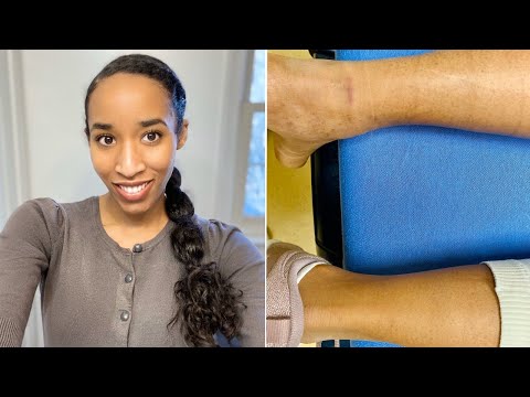 Ruptured Achilles Tendon: Week 1- What Should I Expect?