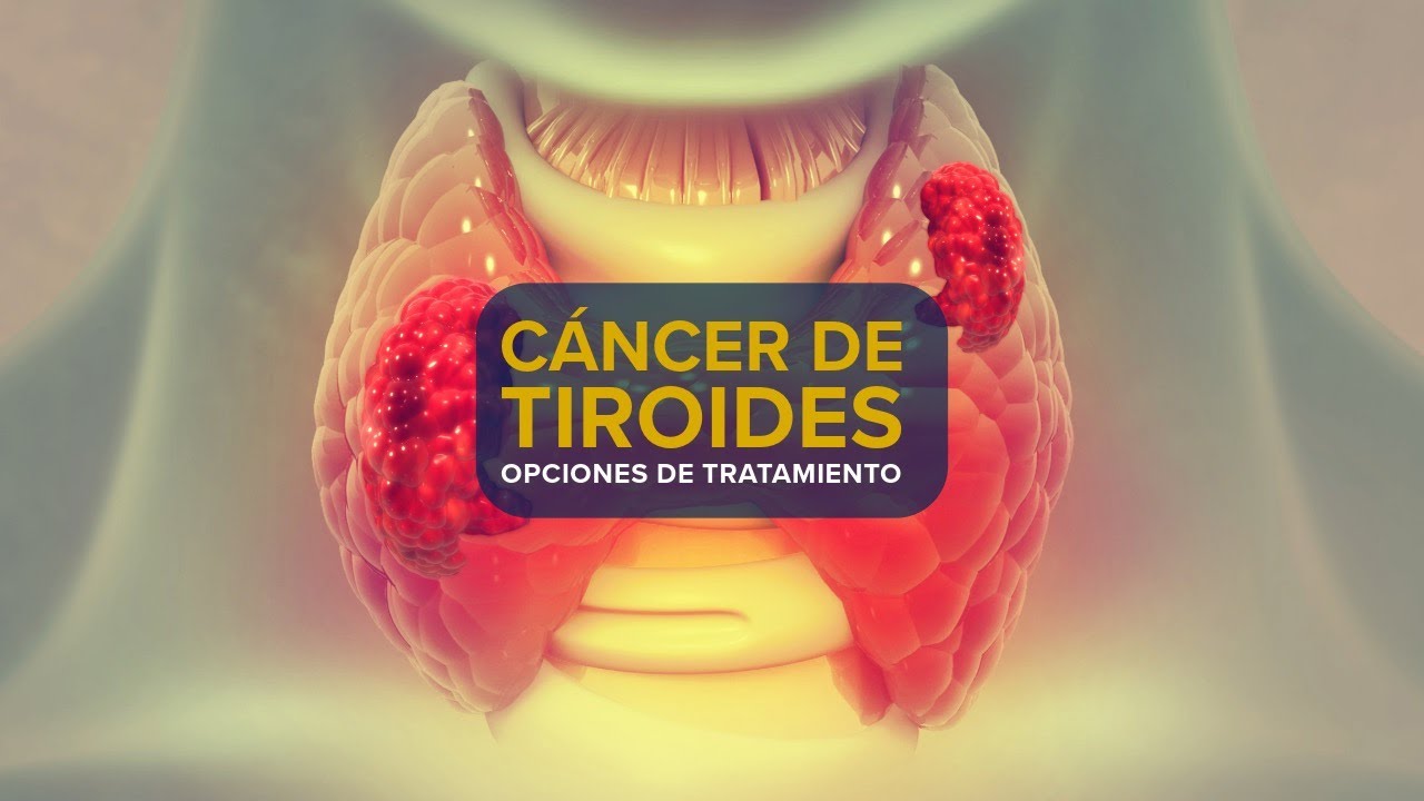 Thumbnail preview of Cáncer de tiroides - Opciones de tratamiento