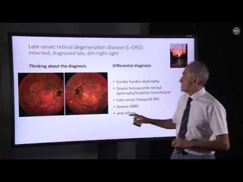 What is late onset retinal degeneration (L-ORD)?”