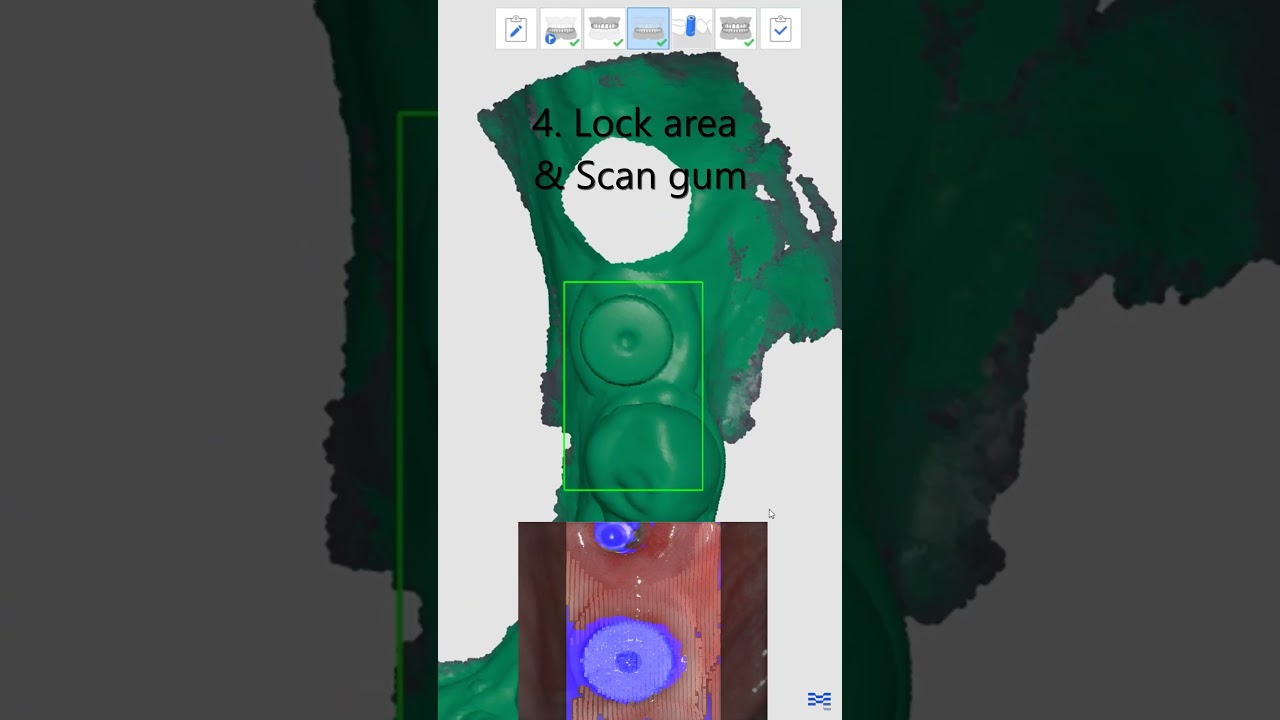 Implant Scan with Scanbody #shorts
