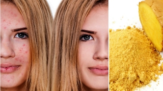 How to Get Rid Of Acne With Ginger - Acne Treatmen
