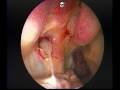Endoscopic Drainage of a Type 2 Hypoplastic Maxillary Sinus
