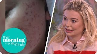 Toff Bravely Removes Her Makeup as She Seeks Help for Her Problem Skin | This Morning