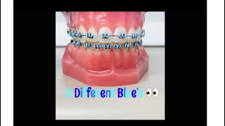 5 Different Colors Of Blue(Braces Design)