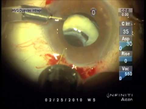 Scleral fixation of dislocated IOL bag complex