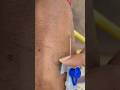 LOCATING DIFFICULT VEINS FOR IV CANNULATION IV CANNULA