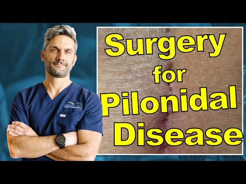 Pilonidal Disease Surgery Updated - What are the options?