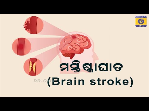 BRAIN STROKE || ମସ୍ତିଷ୍କ ଆଘାତ
