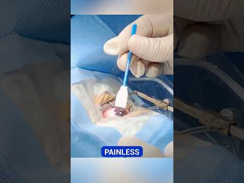 Contoura Vision/ Topo-guided Lasik Procedure