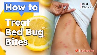 12 Easy Steps to Treat Bed Bug Bites | How to Treat Bed Bug Bites | Best choices