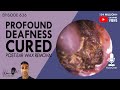 636 - Profound Deafness Cured Post Ear Wax Removal