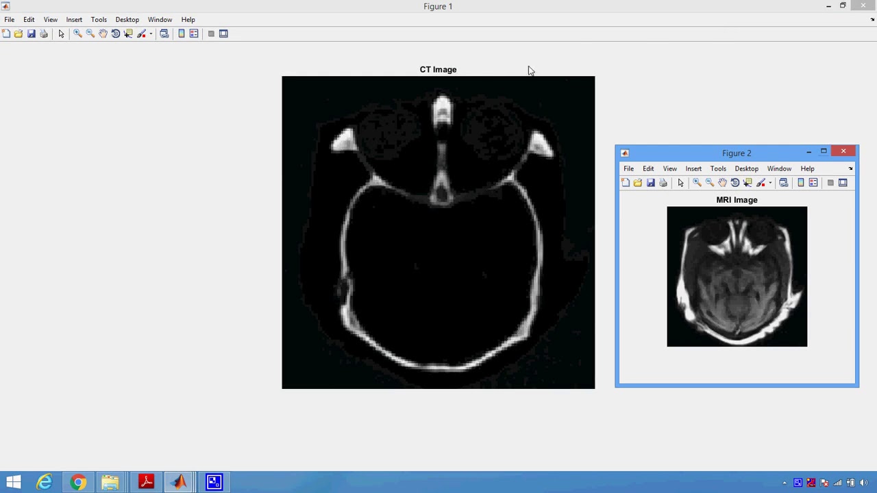 Predicting CT image from MRI Data through Feature Matching with Learned in Matlab OKOK