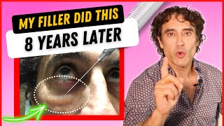 MY UNDER EYE FILLER REACTION 8 YEARS LATER And HOW I