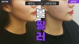 나세르의원 볼필러 전후 및 시술영상