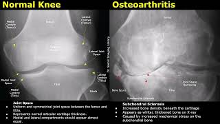 Knee X-Ray Normal Vs Osteoarthritis | AP, Lateral & Skyline Views | Knee Radiography
