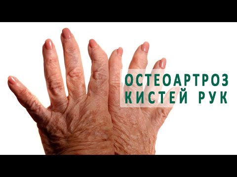 Остеоартроз кистей рук