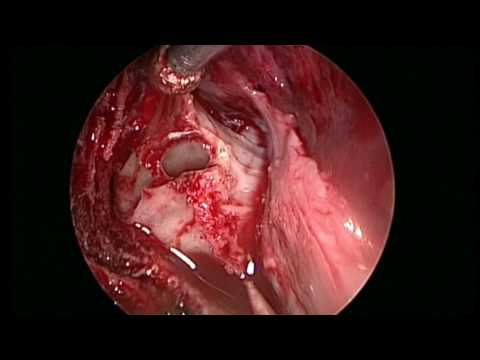 Endoscopic Endonasal Resection Of GH-Secreting Pituitary Adenoma