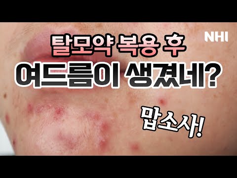 탈모약 복용 후 여드름이 생겼네? - 뉴헤어 I 탈모치료