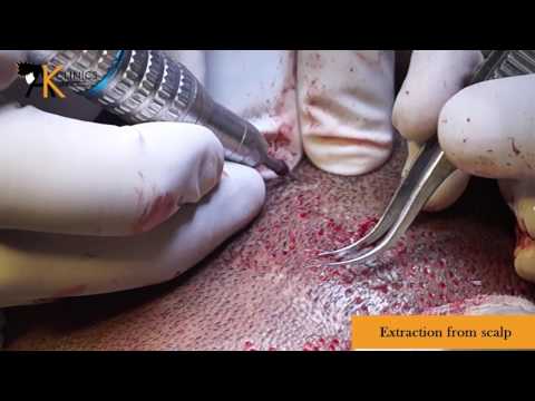 Extraction from Scalp & Beard in Patient of Curly Hair