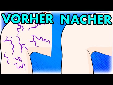 Varicose veins: The only exercise that restores vein valves and improves blood circulation!