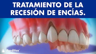 Encías retraídas - Tratamiento de la recesión de encías ©  - Clínica Dental Pardiñas